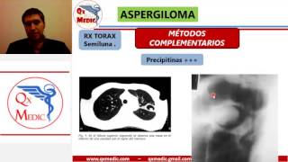 ASPERGILOMA [upl. by Zak]