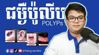 ជម្ងឺប៉ូលីបPolyps [upl. by Avonasac]