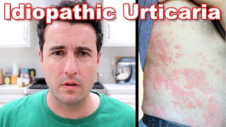 Chronic Idiopathic Urticaria ✨UPDATE✨ [upl. by Pollard223]