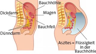 Aszites Innere Medizin Ursache Diagnose und Therapie [upl. by Enitsud472]