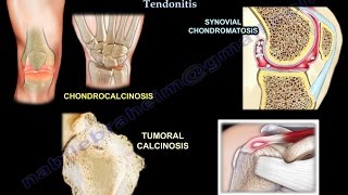 Chondrocalcinosis Tumoral Calcinosis synovial chondromatosis and calcific tendonitis [upl. by Moitoso]