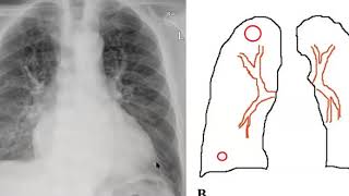 Vasculatura pulmonar [upl. by Rocco]