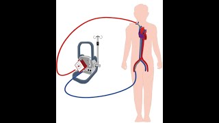 ECMO Complications and TroubleshootingDr Pradeep Rangappa [upl. by Alliber]