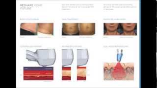 Exilis Before amp After Video [upl. by Ahsiloc]