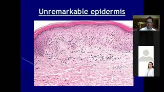 Lecture2 Dermatopathology Lichenoid and Interface Dermatitis [upl. by Erdua]