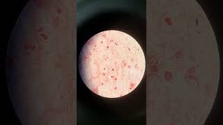 Gram Staining of Sputum Abundant Pus Cells with Absence of Microbial Involvement [upl. by Eiramyma421]