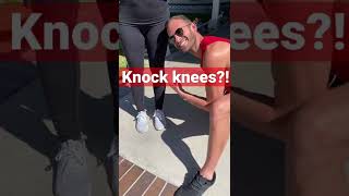 How To Fix Your Knock Knees From Home… Grab a Pillow knockknees kneepain walking [upl. by Sirama]