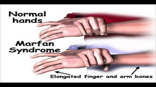 Marfan Syndrome [upl. by Bogie475]