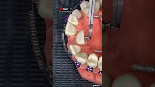 ¡🔥Instalcion de botón de ortodoncia durante el tratamiento de los brackets 😬🔥 [upl. by Siddon483]