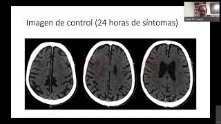 ENARM 2021 clase de Neurorradiología [upl. by Polloch300]