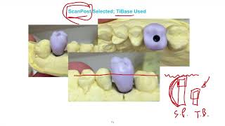 CEREC TiBase Lecture Series Lesson 05 [upl. by Leunamnauj905]