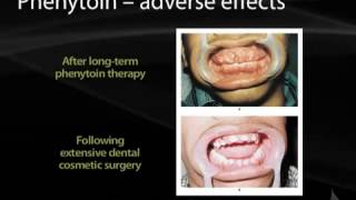 18 Antiepileptics pharmacology [upl. by Milde]