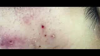 Big Cystic Acne Blackheads Extraction Blackheads amp Milia Whiteheads Removal Pimple Popping [upl. by Giana94]