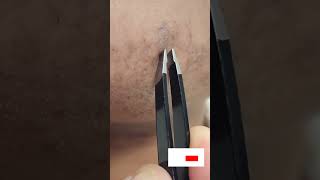 Tweezing Stubborn Facial Hairs Ingrown Hairs Facial Hair Extraction [upl. by Sherill]