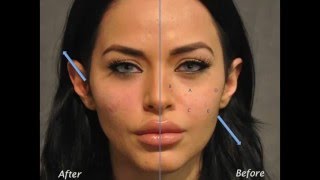 Beverly Hills Model  Actress  Cheek Augmentation for under eyes contour and mouth folds [upl. by Pan494]