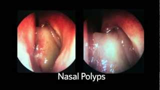 AAOHNSF The ENT Exam Episode 4 The Nasopharynx and Larynx Exam [upl. by Delly34]