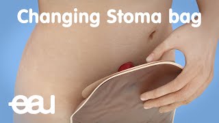 Changing stoma bag after bladder cancer treatment [upl. by Sully533]