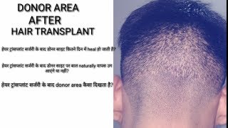 DONOR AREA AFTER HAIR TRANSPLANT  डोनर एरिया  हेयर ट्रांसप्लांट के बाद [upl. by Mencher]