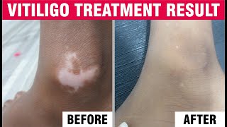 Best Vitiligo treatments  Vitiligo treatments specialist  Sakhiya Skin Clinic Review [upl. by Jopa]