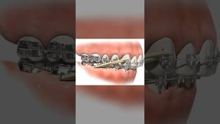 Class II elastics in Orthodontics braces teeth dental allaboutbraces [upl. by Belldas]