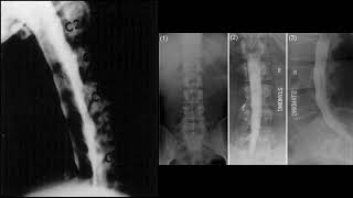 Mielografía cervical y dorsolumbar [upl. by Olnay]