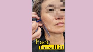 Thread Lift Thread Lift Gone Wrong [upl. by Aprile]