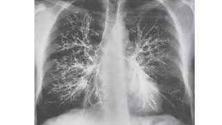 Posteroanterior bronchogram of chest [upl. by Descombes429]