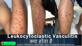 Leukocytoclastic Vasculitis  sudden red rashes  red spot on leg palpable purpura Dr Uttam Lenka [upl. by Suivatnod]