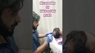 Microneedling for Hair loss  Hair growth  PRP growth factors hairrestoration draqeel skincare [upl. by Zanze]