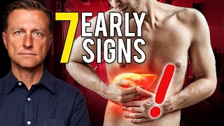 7 Early Signs of Liver Damage [upl. by Cyn]