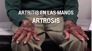 Artritis en las manos – Artrosis [upl. by Myrtie19]