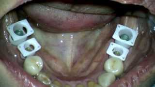 Snap on impression of Straumann tissue level implant in posterior mandible [upl. by Maximilien92]