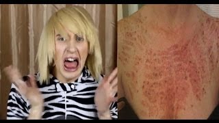 IPL Laser Hair Removal BAD SIDE EFFECTS [upl. by Hafeenah302]