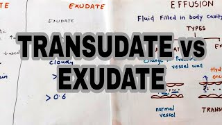 Transudate vs Exudate  Types of effusion  lights criteria [upl. by Lattonia]