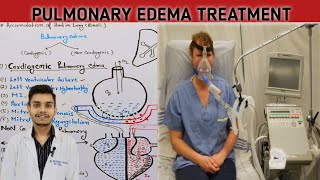 Pulmonary edema diagnosis treatment in Hindi  pulmonary edema treatment [upl. by Natika860]