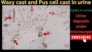 Urine casts under microscope  Waxy cast  Pus cell cast  medicallabtechnologysajal6903 [upl. by Aelegna]