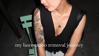 Laser Tattoo Removal in NYC Session 1 [upl. by Aprile]