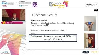 Bone Block in combination with ASA Raffaele Russo [upl. by Eelyak]