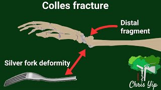 Distal radius fracture eponyms animated [upl. by Ehr]