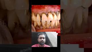 tartar removal teeth tartar tartarremovalteeth teethtartar short shortsfeed [upl. by Vaughan]