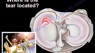 Knee Pain  Meniscus tear  Everything You Need To Know  Dr Nabil Ebraheim [upl. by Fania110]