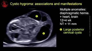 Cystic hydroma and nuchal edema at 1113 weeks of pregnancy [upl. by Patsis]