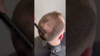 Hair Loss Transformation using Hair powder for Thin amp Balding Head [upl. by Hemetaf]