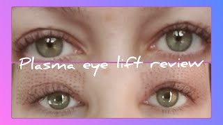 plasma fibroblast eye lift review  mid way through treatment [upl. by Eide]