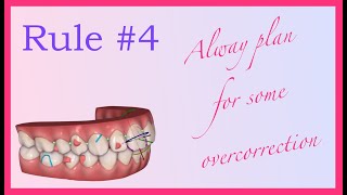 Overcorrection and whereabouts  Invisalign Mini Course 5 of 8 [upl. by Care]