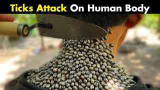 Ticks Bites On Human  Symptoms Causes And Treatment [upl. by Eadmund]