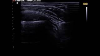 Ultrasound Guided Subacromial Bursa Injection [upl. by Sandberg]