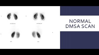 Static Renal Scintigraphy MCQ DMSA RenalScintigraphy renalscan scfhs nuclearmedicineMCQ [upl. by Asiuol]