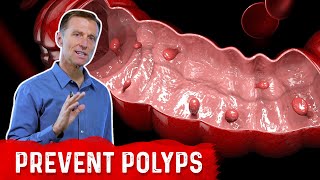 What is a Polyp – The Best Food for Colon Polyp Prevention – Dr Berg [upl. by Callean659]