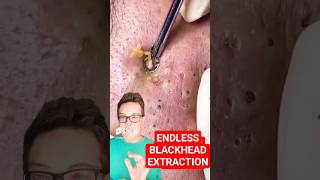 Endless BLACKHEAD REMOVAL  Crazy Satisfying shorts [upl. by Ailaht]